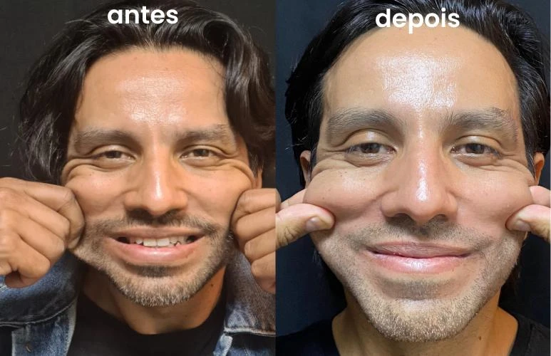 Bioestimulador de colágeno facial