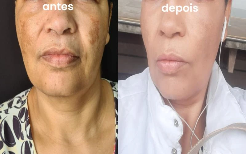 Laser para melasma na Bela Vista